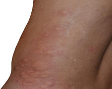 Аллергические реакции на коже в виде отека и красноты.